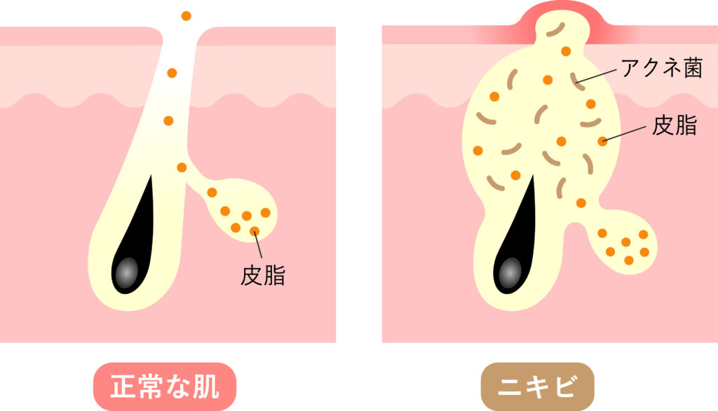 ニキビの原因