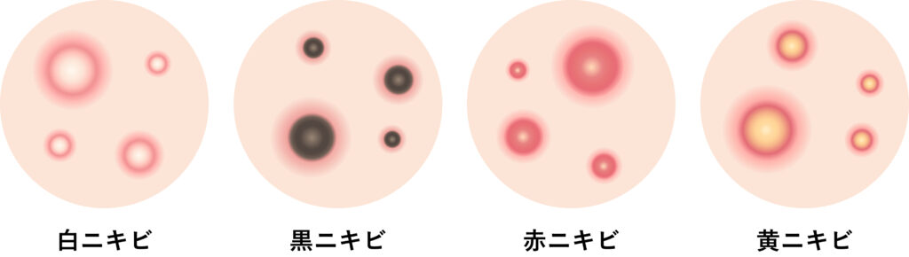 あなたのニキビはどの種類？