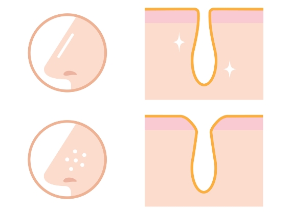 1.毛穴の開き