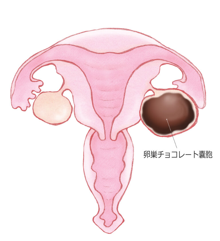 子宮内膜症