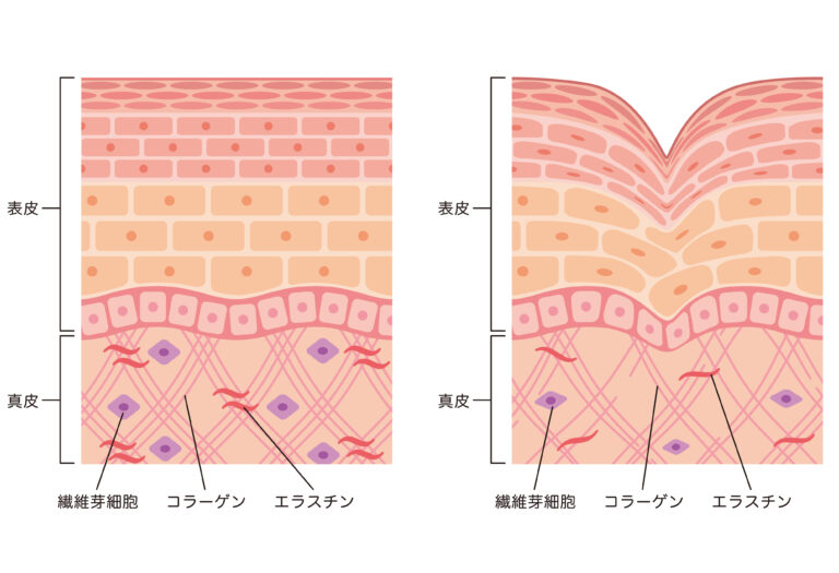 しわができる原因