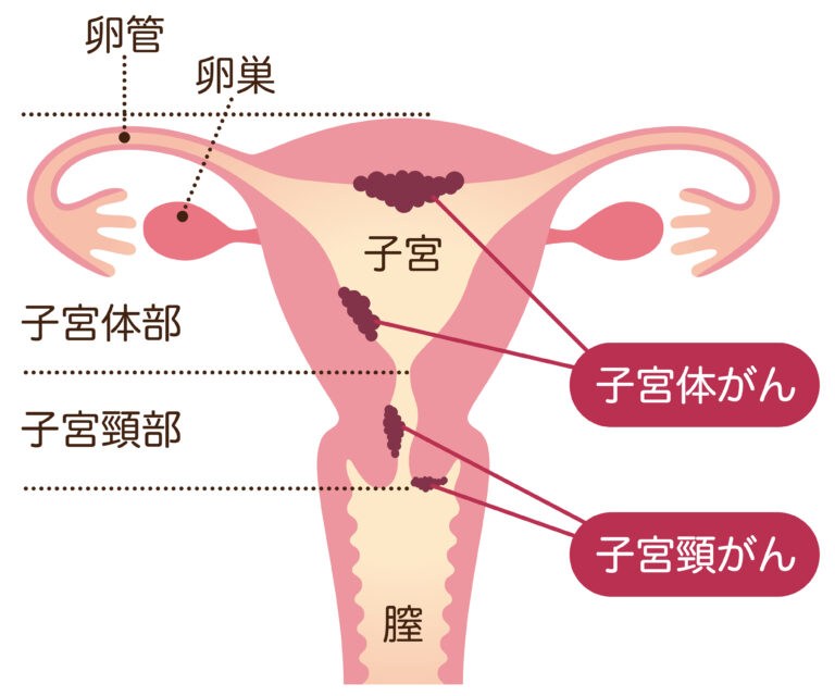 子宮肉腫:種類、症状、見通し